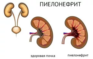 Пиелонефрит: симптомы, лечение, профилактика